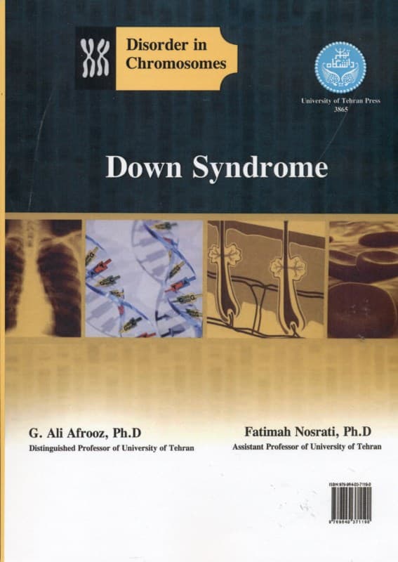 سندرم داون (اختلال در کروموزوم‌ها)
